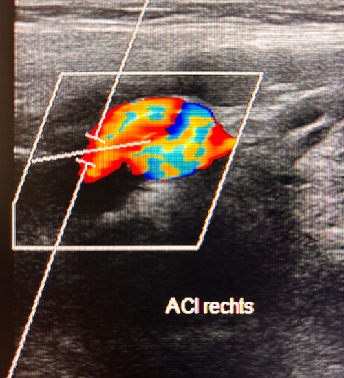 Ultraschall der Halsschlagader bei einer Normvariante